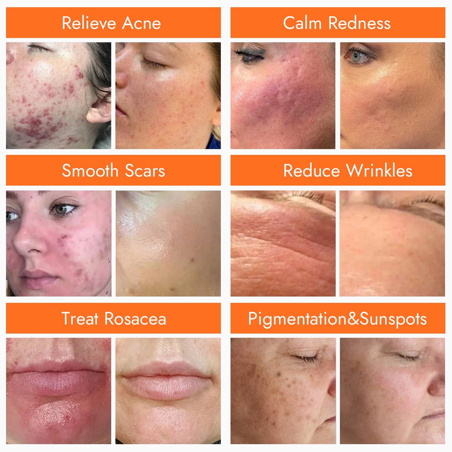 Defenni U-Shape Pro LED Light Therapy Device